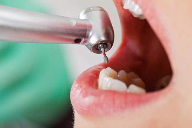 Best Emergency Broken Tooth Repair in USA